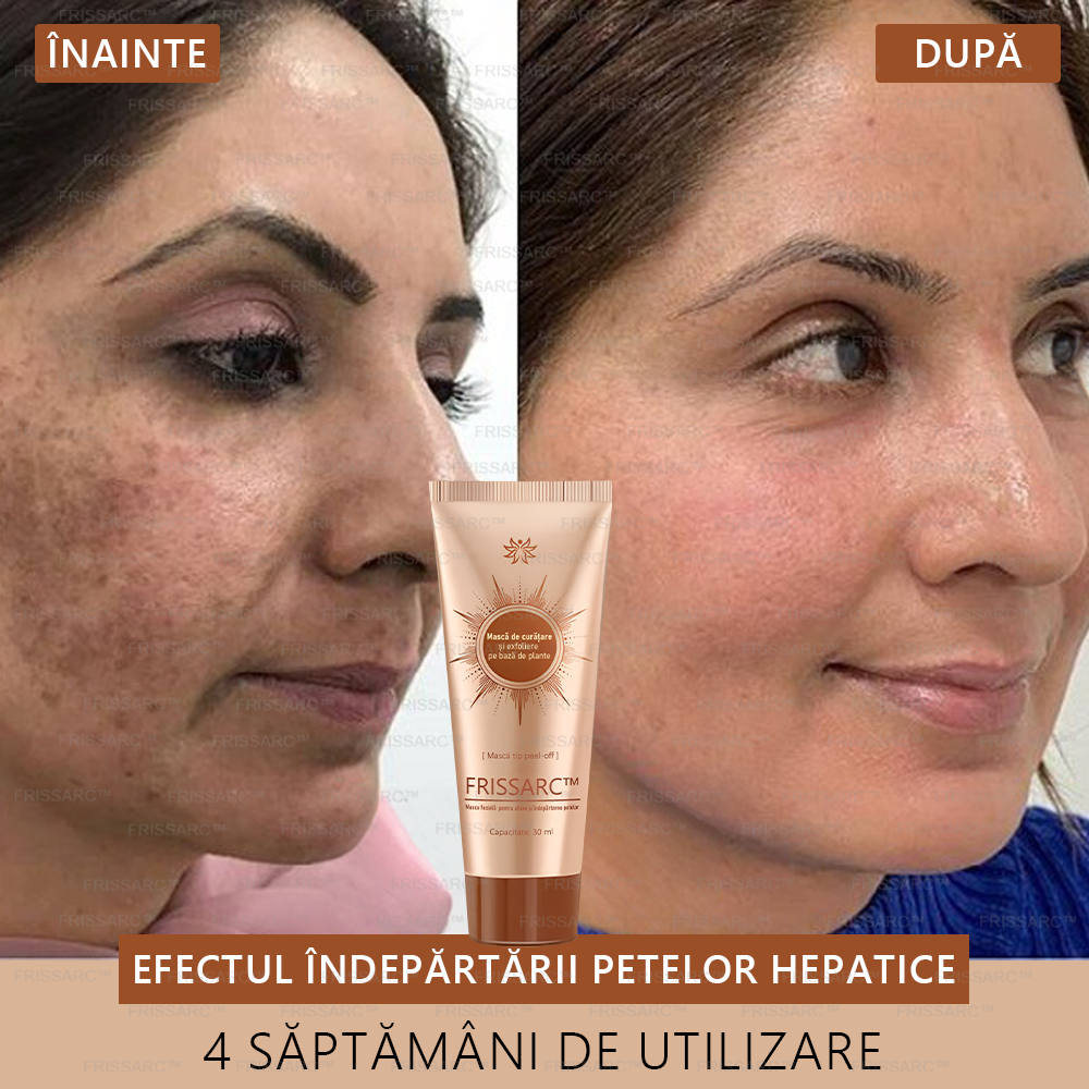 🎁FRISSARC™ masca facială  pentru albire și îndepărtarea petelor –🍀Ingredientele naturale ajută la eliminarea eficientă și de durată a petelor pigmentare, petelor de vârstă, pistruilor și petelor solare.🎁